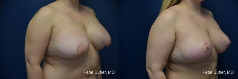 Breast Lift Before and After Photo by Dr. Butler in Pensacola Florida