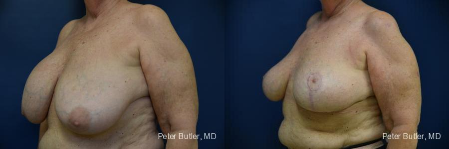 Breast Lift Before and After Photo by Dr. Butler in Pensacola Florida