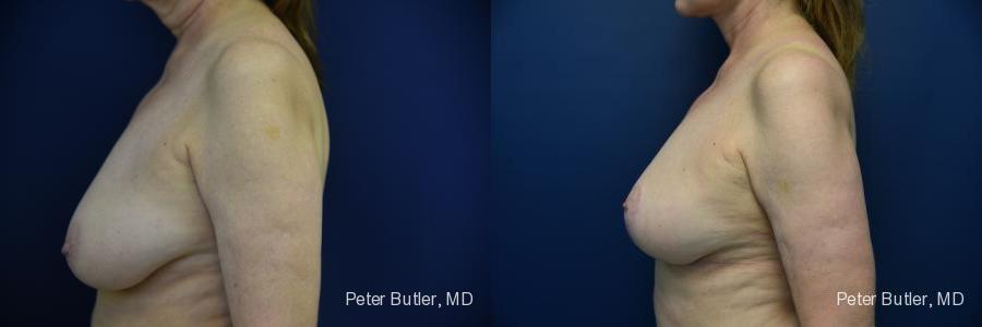 Breast Lift with Fat Before and After Photo by Dr. Butler in Pensacola Florida