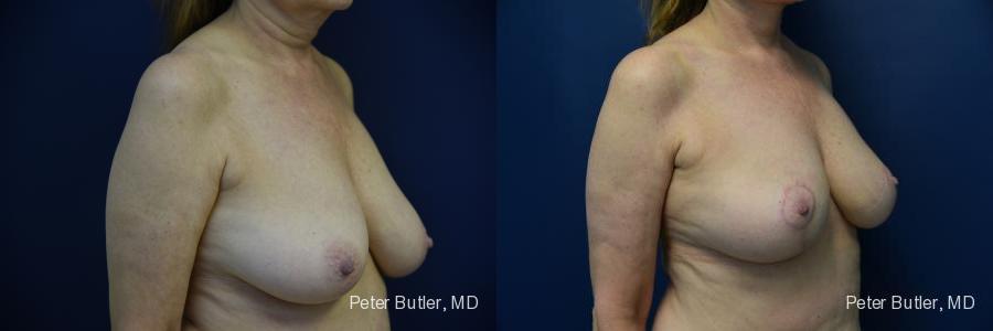 Breast Lift with Fat Before and After Photo by Dr. Butler in Pensacola Florida
