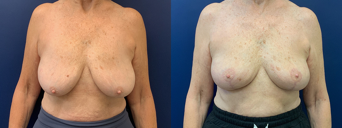 Breast Lift With Implant Removal Before and After Photo by Dr. Butler in Pensacola Florida