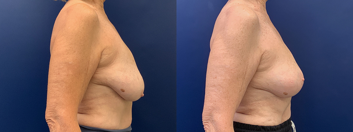 Breast Lift With Implant Removal Before and After Photo by Dr. Butler in Pensacola Florida