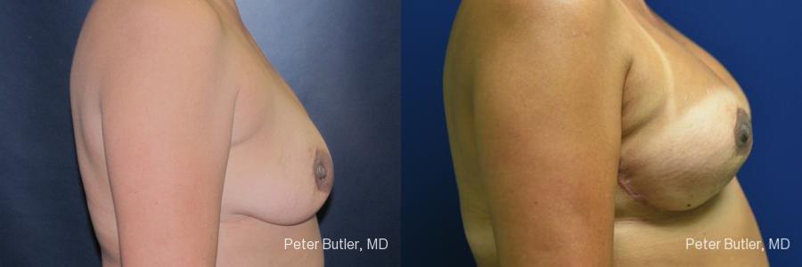 Breast Reconstruction Before and After Photo by Dr. Butler in Pensacola Florida