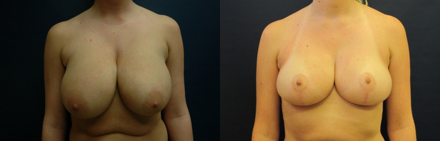 Breast Reduction Before and After Photo by Dr. Butler in Pensacola Florida
