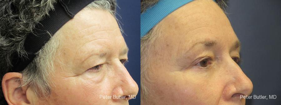 Brow Lift Before and After Photo by Dr. Butler in Pensacola Florida