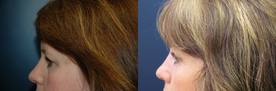 Brow Lift Before and After Photo by Dr. Butler in Pensacola Florida