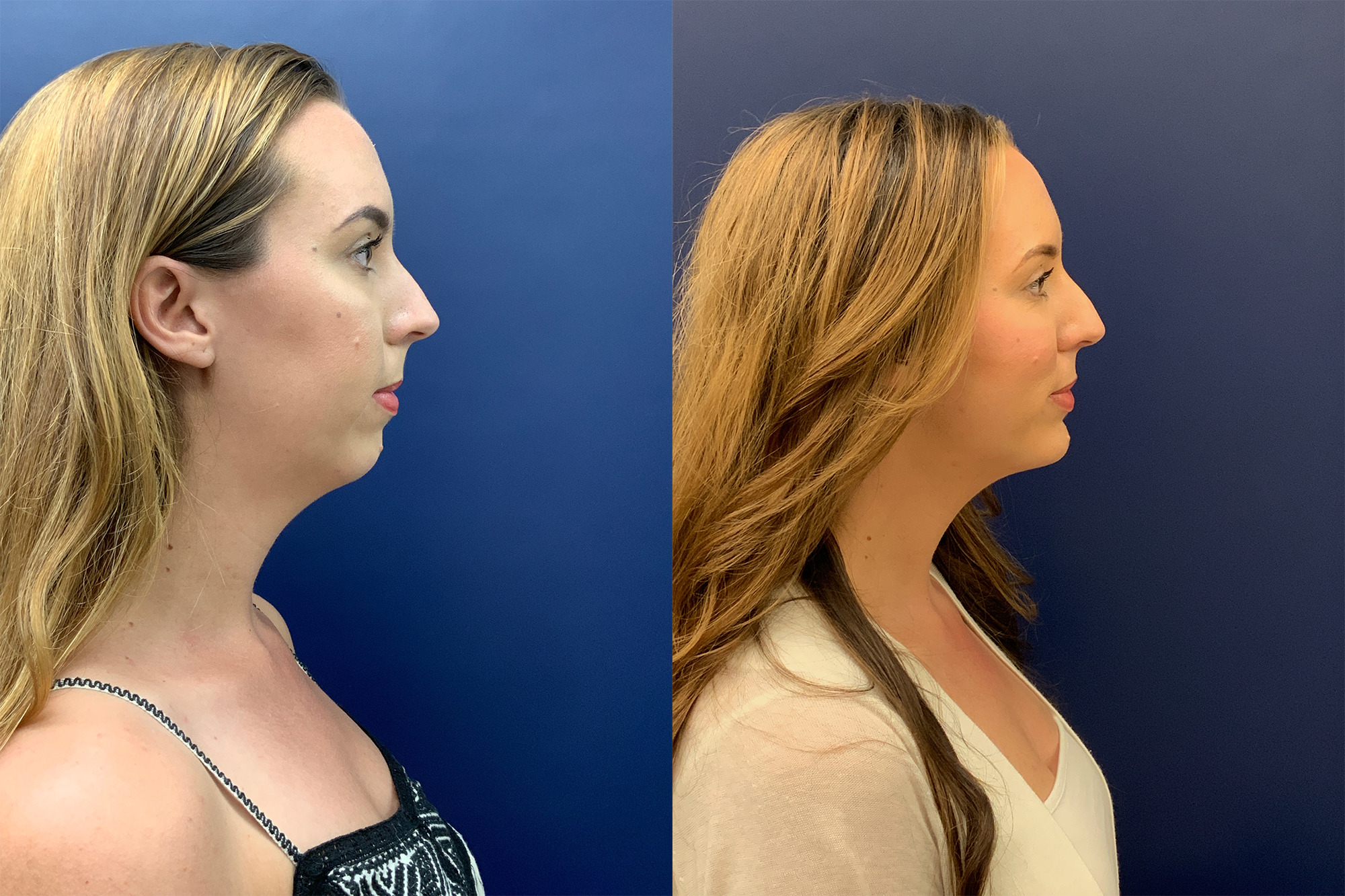 Chin Implant Before and After Photo by Dr. Butler in Pensacola Florida