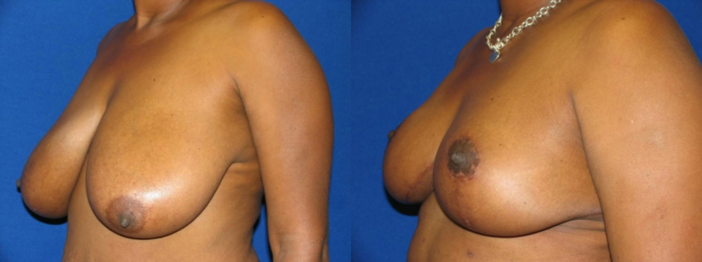 Breast Reduction Before and After Photo by Dr. Leveque of Gulf Coast Plastic Surgery in Pensacola, FL
