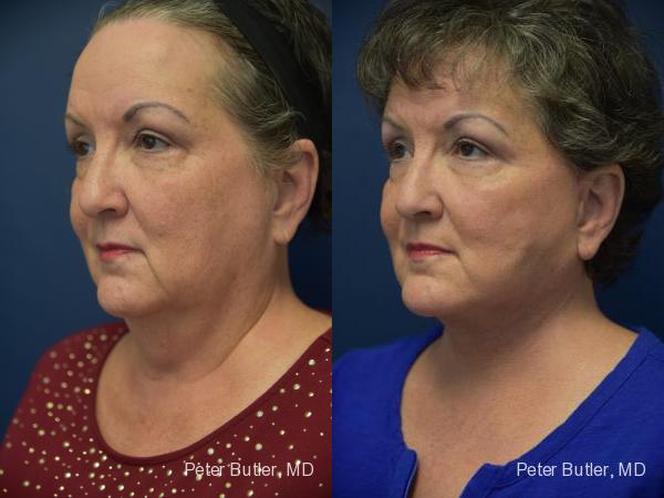 Facelift Before and After Photo by Dr. Butler in Pensacola Florida