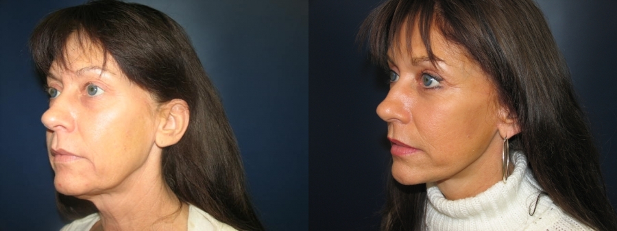 Facelift Before and After Photo by Dr. Butler in Pensacola Florida