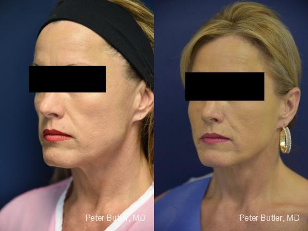 Fat Transfer to Face Before and After Photo by Dr. Butler in Pensacola Florida