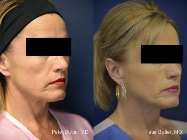 Fat Transfer to Face Before and After Photo by Dr. Butler in Pensacola Florida