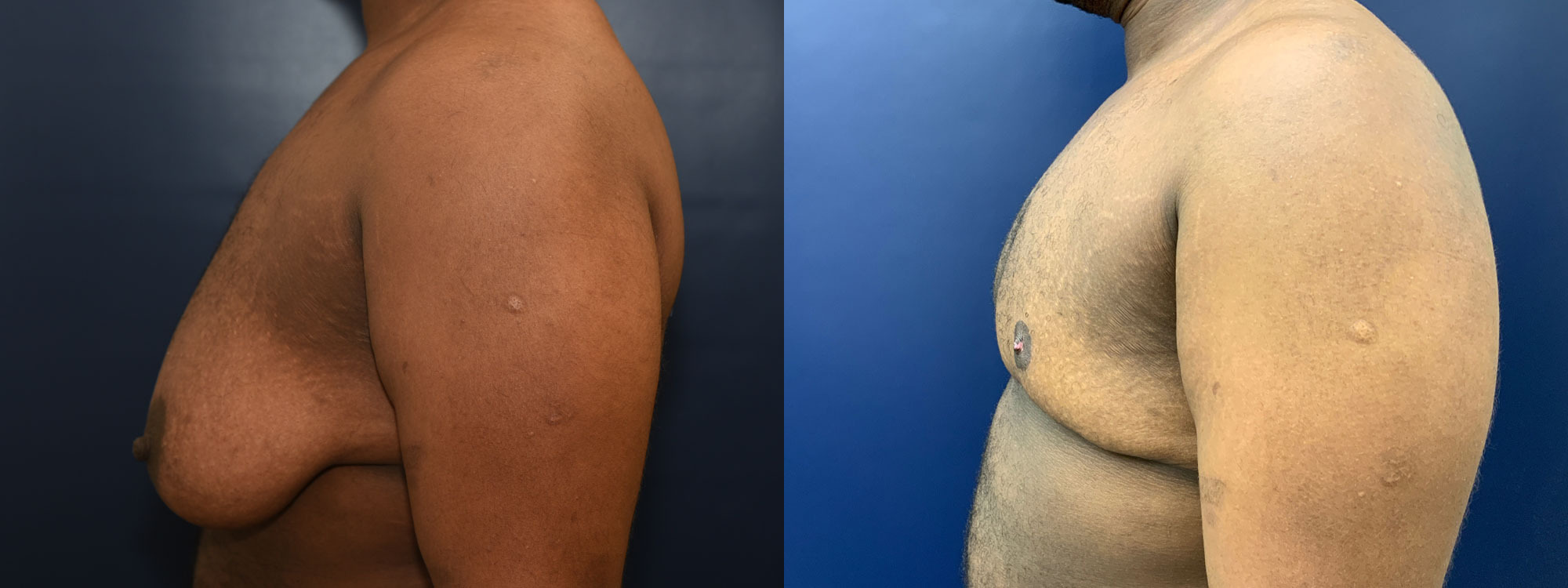 Female to Male Top Surgery Before and After Photo by Dr. Butler in Pensacola Florida