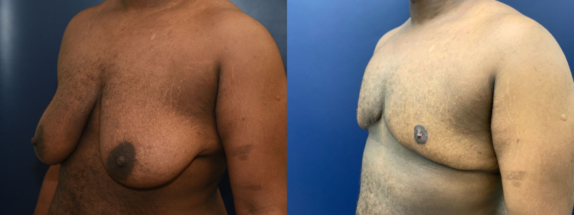 Female to Male Top Surgery Before and After Photo by Dr. Butler in Pensacola Florida