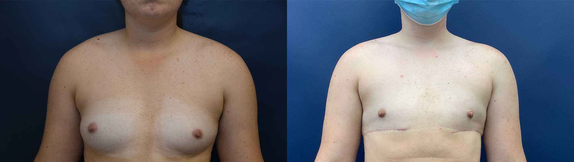 Female to Male Top Surgery by Dr. Butler Before and After Photo by Dr. Butler in Pensacola Florida