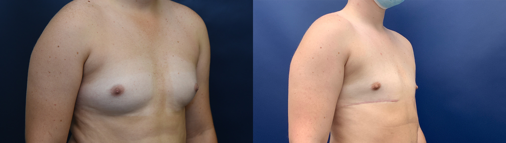 Female to Male Top Surgery by Dr. Butler Before and After Photo by Dr. Butler in Pensacola Florida