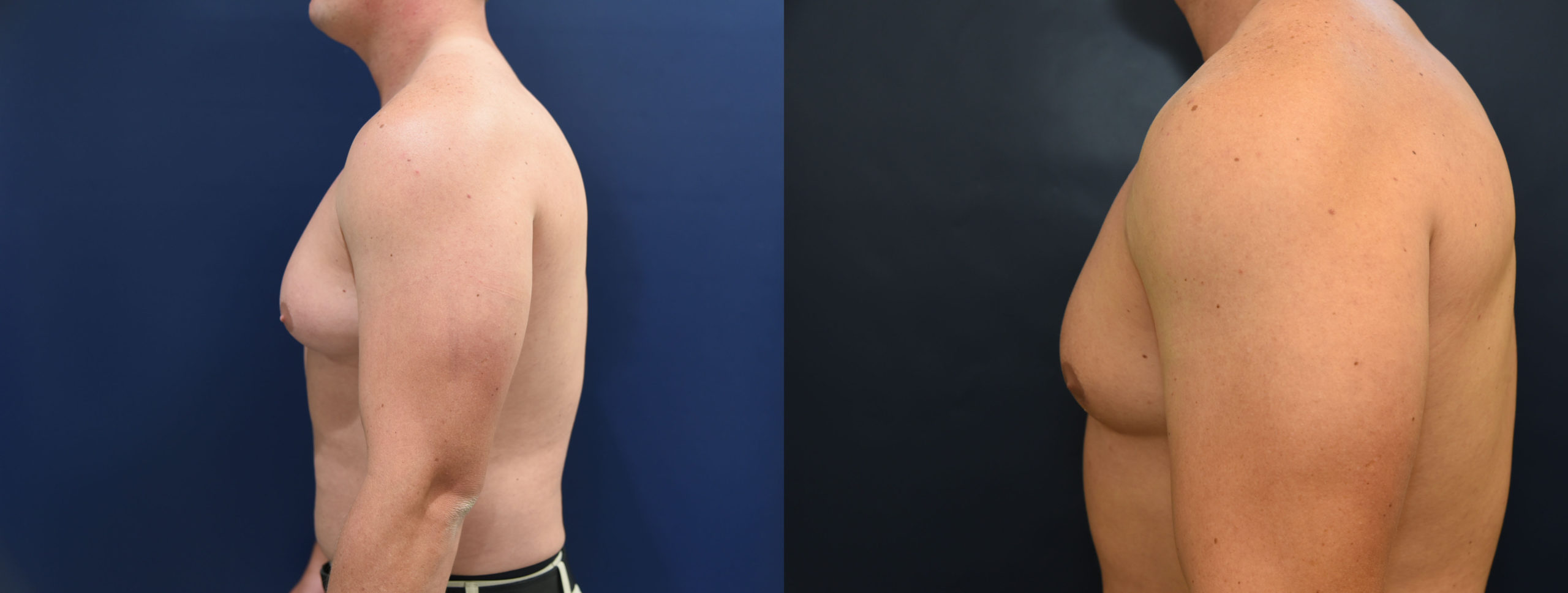 Gynecomastia Before and After Photo by Dr. Butler in Pensacola Florida