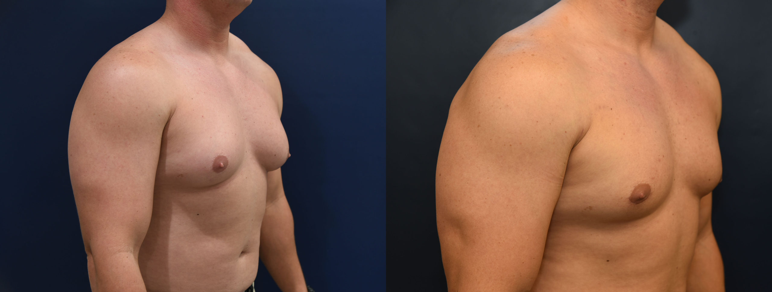 Gynecomastia Before and After Photo by Dr. Butler in Pensacola Florida