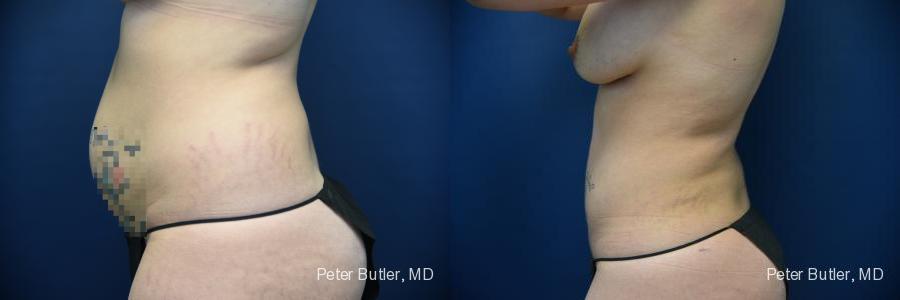 Liposuction Before and After Photo by Dr. Butler in Pensacola Florida