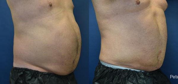 Liposuction Before and After Photo by Dr. Butler in Pensacola Florida