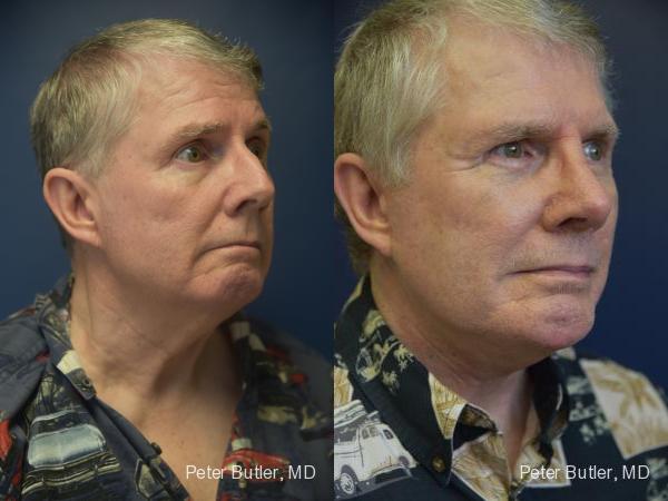 Liposuction of Neck Before and After Photo by Dr. Butler in Pensacola Florida