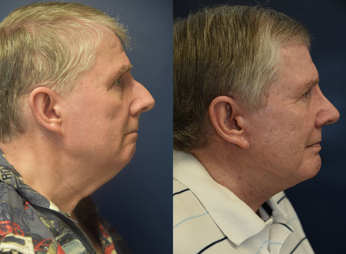 Chin Implant Before and After Photo by Dr. Butler in Pensacola Florida