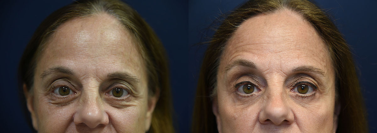 Lower Eyelid Lift Before and After Photo by Dr. Butler in Pensacola Florida
