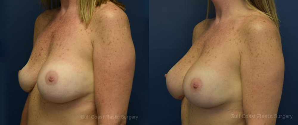 Breast Implant Exchange Before and After Photo by Dr. Leveque of Gulf Coast Plastic Surgery in Pensacola, FL