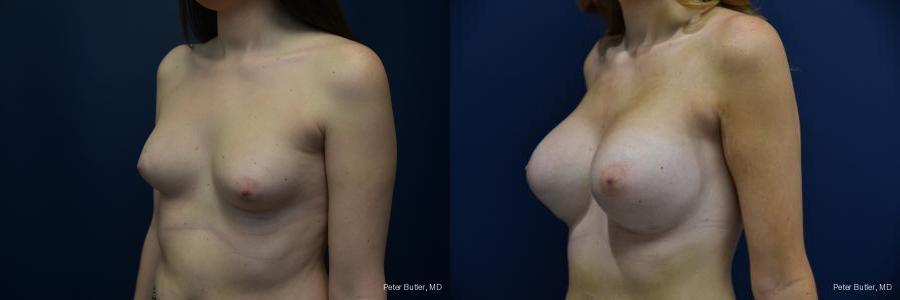Male to Female Top Surgery Before and After Photo by Dr. Butler in Pensacola Florida