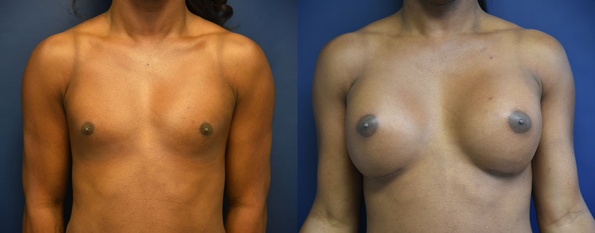 Male to Female Top Surgery Before and After Photo by Dr. Butler in Pensacola Florida
