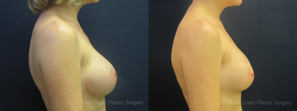 Breast Implant Exchange Before and After Photo by Dr. Leveque of Gulf Coast Plastic Surgery in Pensacola, FL