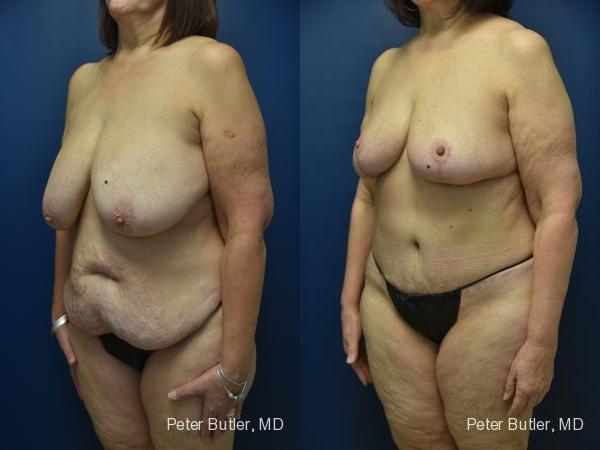 Mommy Makeover Before and After Photo by Dr. Butler in Pensacola Florida