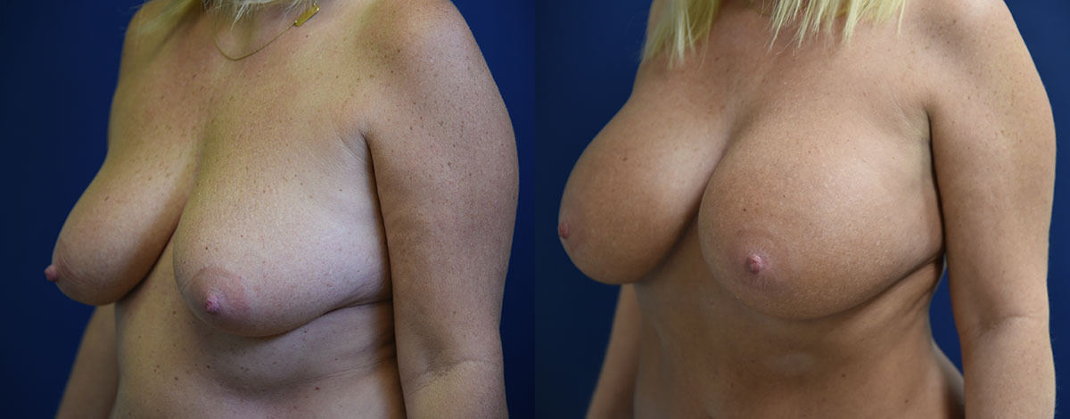 Mommy Makeover Before and After Photo by Dr. Butler in Pensacola Florida