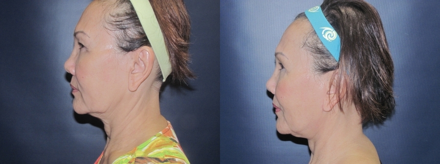 Neck Lift Before and After Photo by Dr. Butler in Pensacola Florida