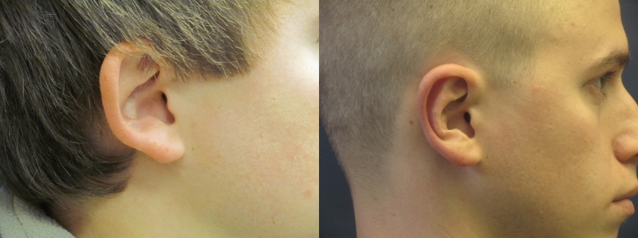 Otoplasty and Earlobe Repair Before and After Photo by Dr. Butler in Pensacola Florida