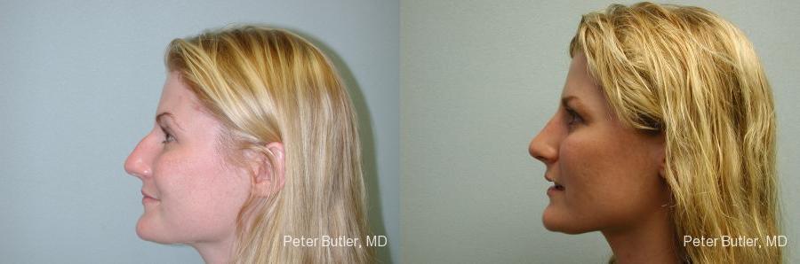 Rhinoplasty Before and After Photo by Dr. Butler in Pensacola Florida
