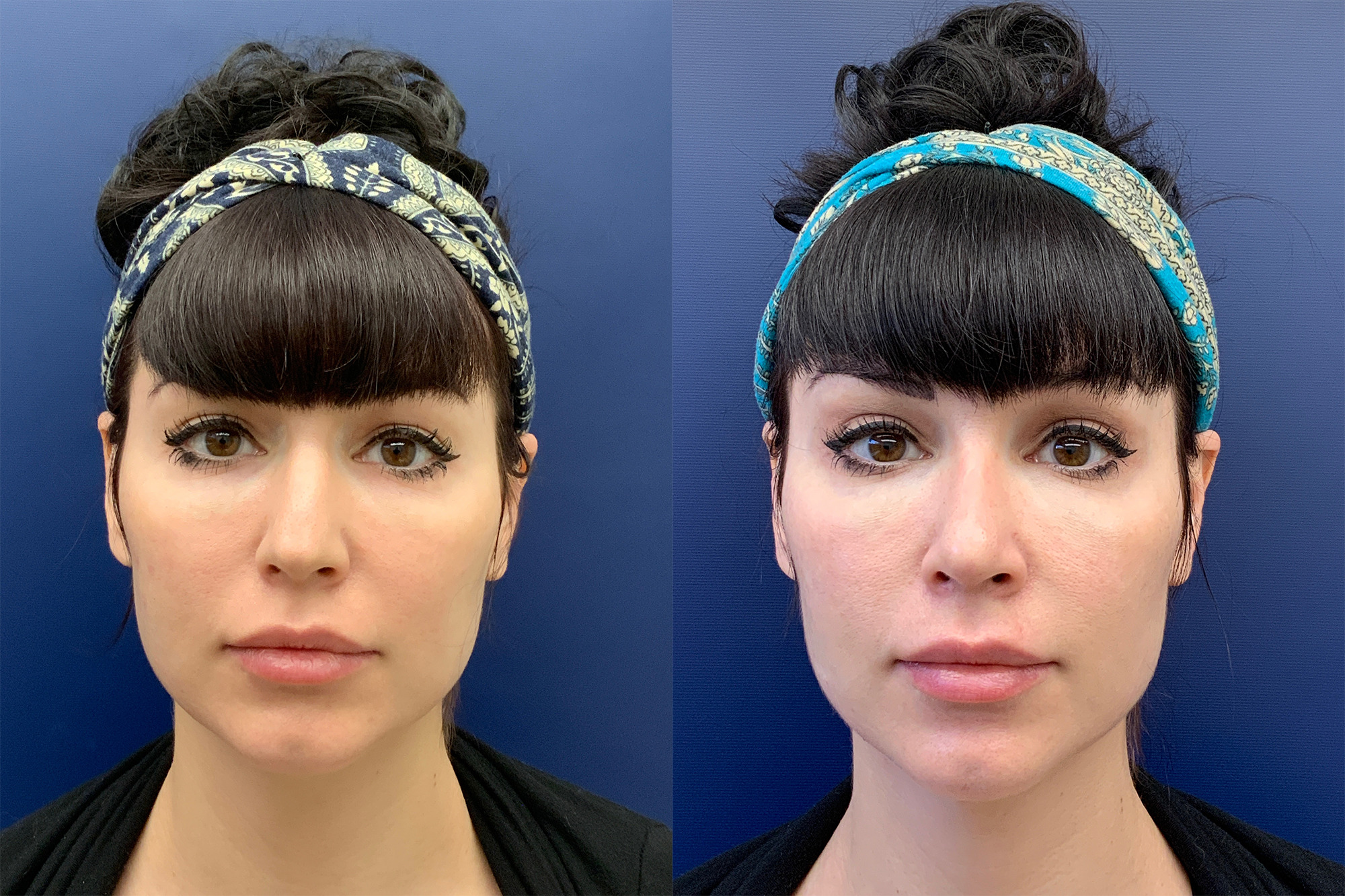 Rhinoplasty Before and After Photo by Dr. Butler in Pensacola Florida