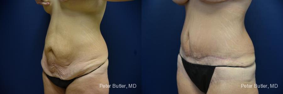 Tummy Tuck Before and After Photo by Dr. Butler in Pensacola Florida