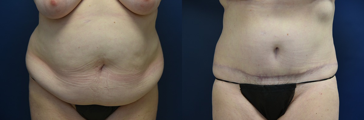 Tummy Tuck Before and After Photo by Dr. Butler in Pensacola Florida