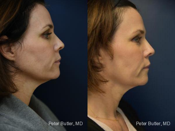 Ulthera Before and After Photo by Dr. Butler in Pensacola Florida