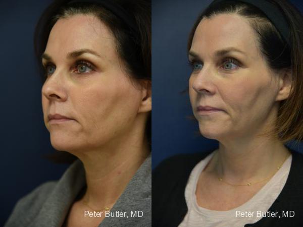 Ulthera Before and After Photo by Dr. Butler in Pensacola Florida