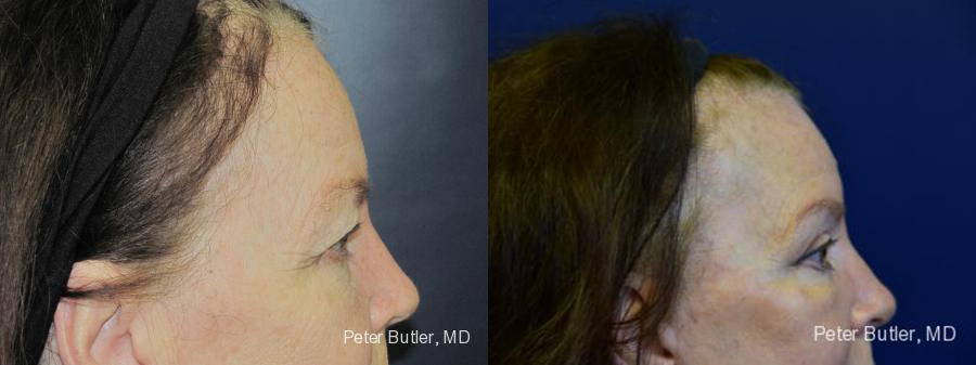 Upper Eyelid Lift Before and After Photo by Dr. Butler in Pensacola Florida