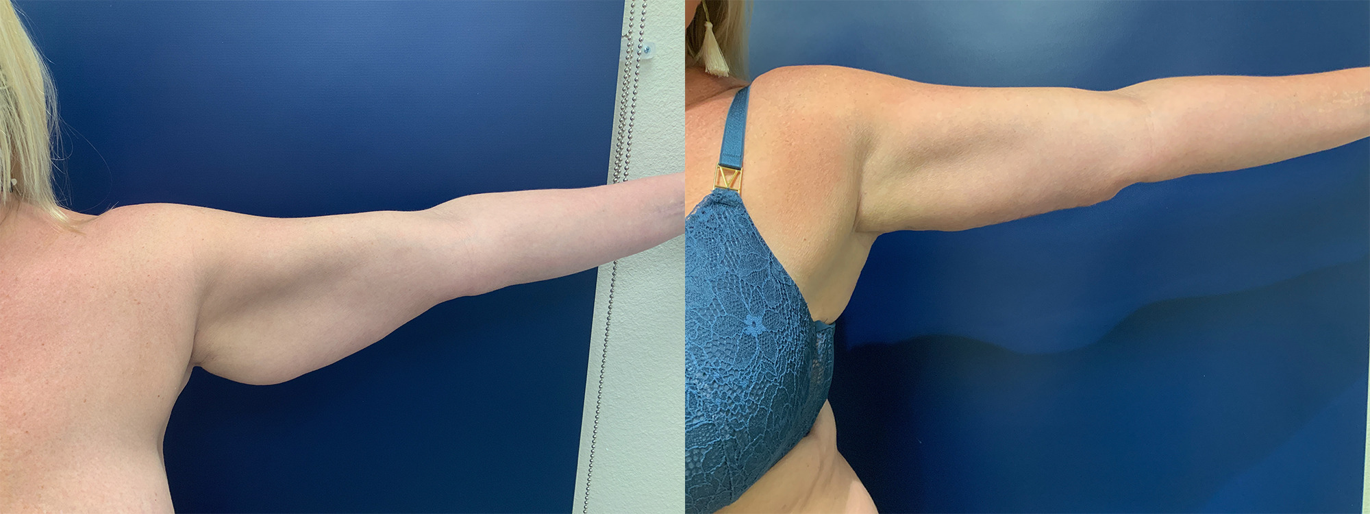 Brachioplasty Before and After Photo by Dr. Patterson in Pensacola Florida