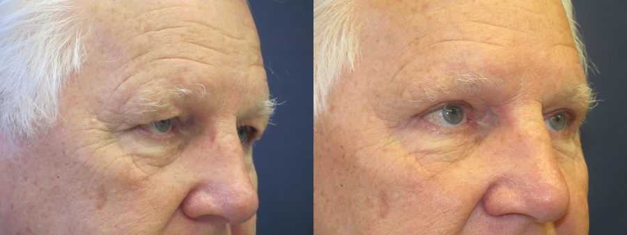 Upper Eyelid Lift Before and After Photo by Dr. Butler in Pensacola Florida