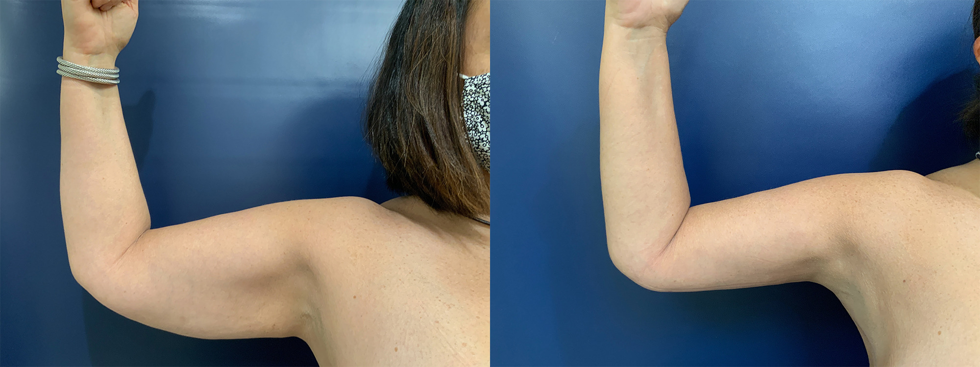 Brachioplasty Before and After Photo by Dr. Patterson in Pensacola Florida