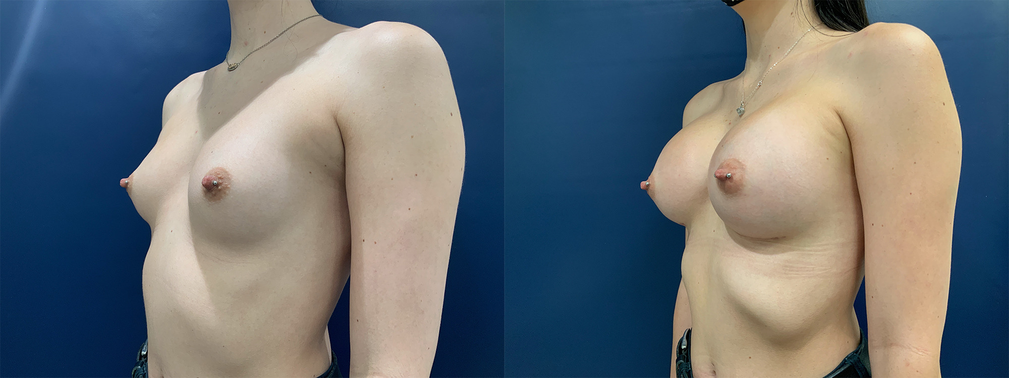 Breast Augmentation Before and After Photo by Dr. Patterson in Pensacola Florida