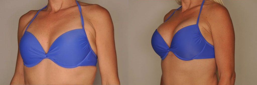 Breast Augmentation Before and After Photo by Dr. Patterson in Pensacola Florida