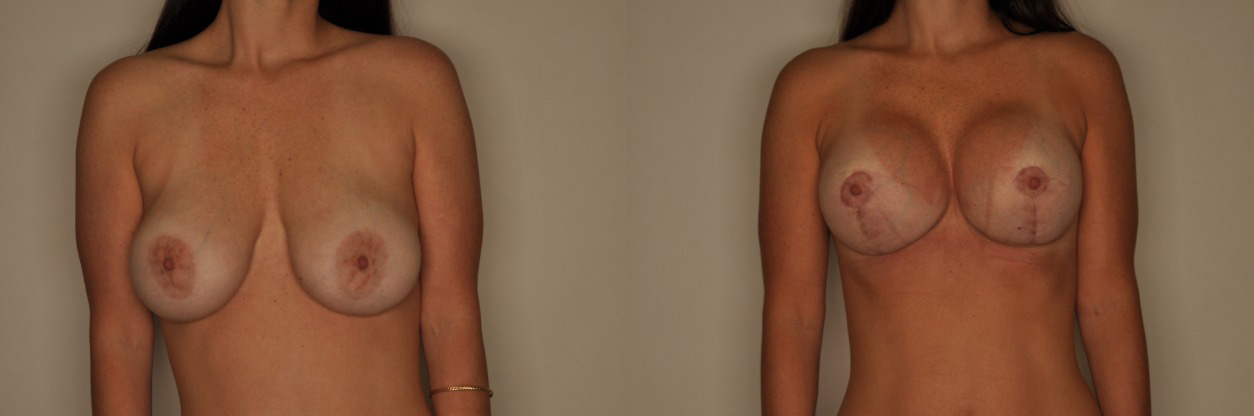 Breast Implant Exchange Before and After Photo by Dr. Patterson in Pensacola Florida