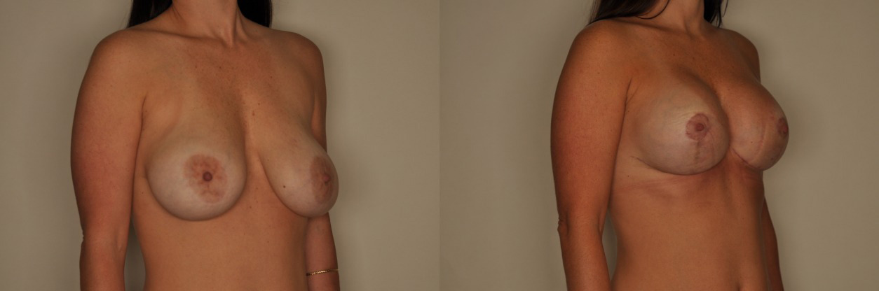 Breast Implant Exchange Before and After Photo by Dr. Patterson in Pensacola Florida