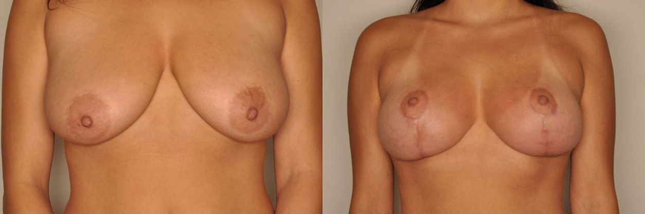 Breast Lift with Augmentation Before and After Photo by Dr. Patterson in Pensacola Florida